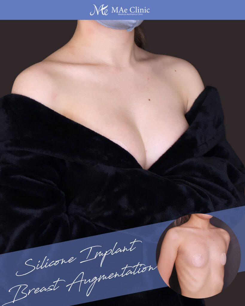 シリコンバッグ豊胸（Motiva Ergonomix2 DEMI） サイズ：両側250ml 木下恵里沙医師シリコンバッグ豊胸症例