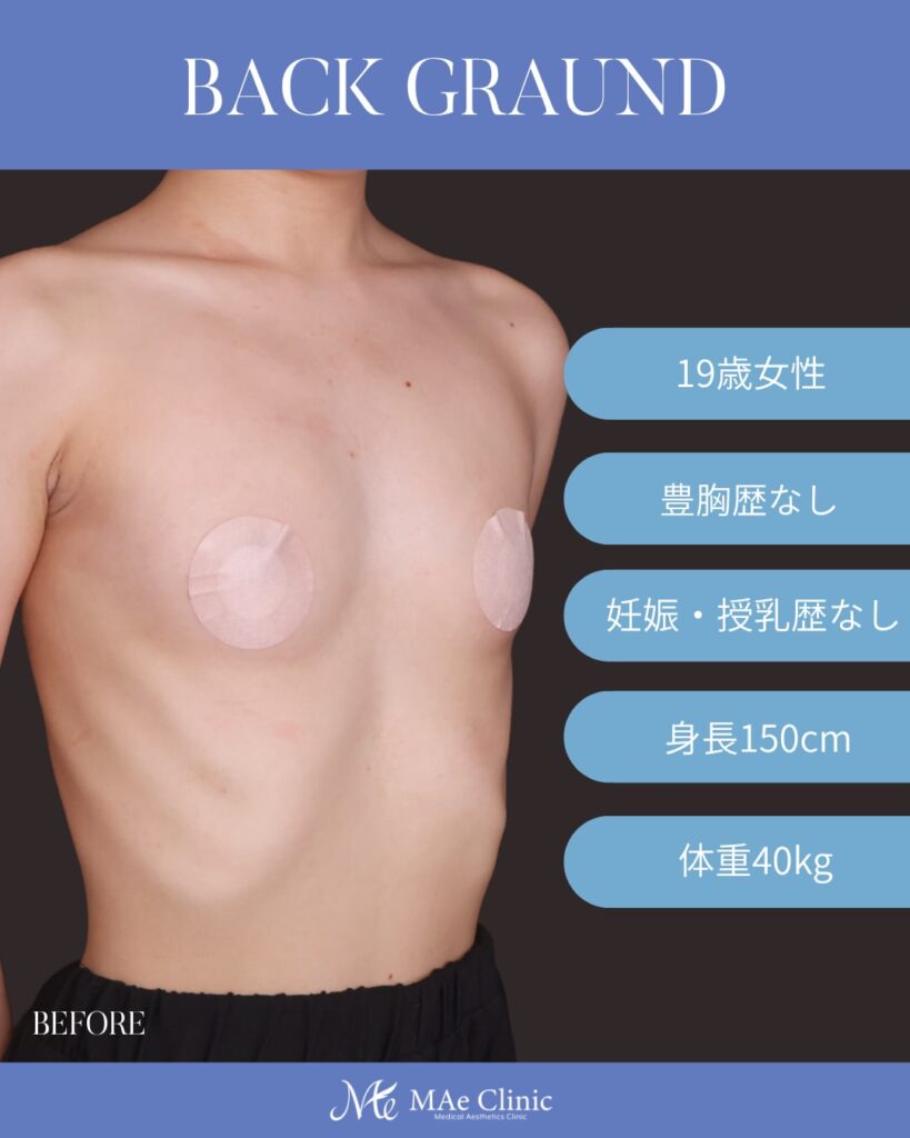 シリコンバッグ豊胸（Motiva Ergonomix2 DEMI） サイズ：両側250ml 木下恵里沙医師シリコンバッグ豊胸症例