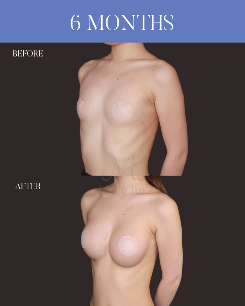 シリコンバッグ豊胸（Motiva Ergonomix2 DEMI） サイズ：両側250ml 木下恵里沙医師シリコンバッグ豊胸症例