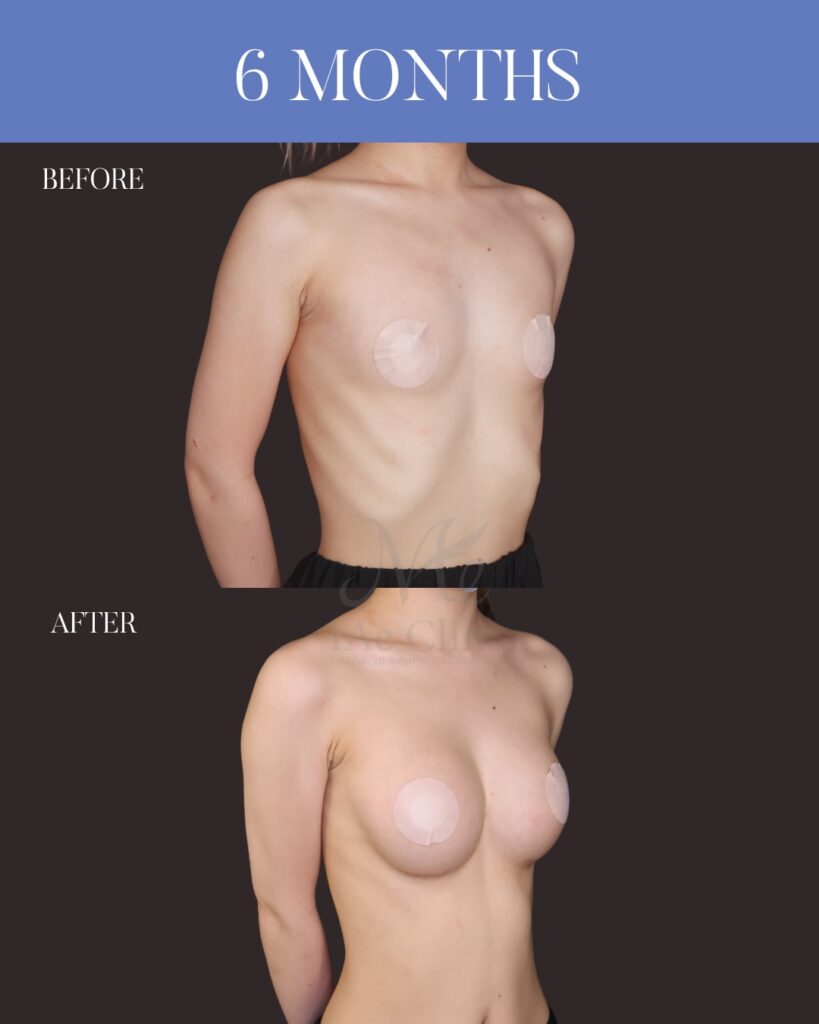 シリコンバッグ豊胸（Motiva Ergonomix2 DEMI） サイズ：両側250ml 木下恵里沙医師シリコンバッグ豊胸症例