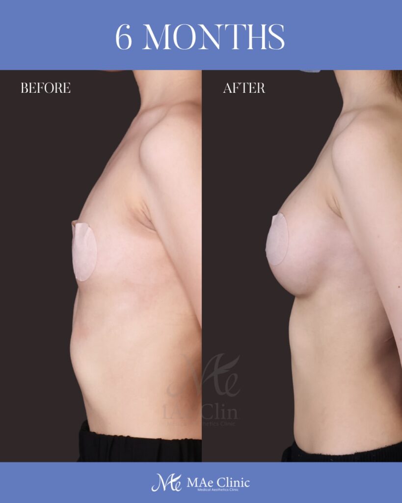 シリコンバッグ豊胸（Motiva Ergonomix2 DEMI） サイズ：両側250ml 木下恵里沙医師シリコンバッグ豊胸症例