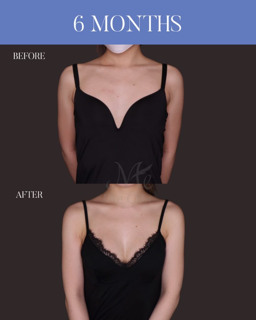 シリコンバッグ豊胸（Motiva Ergonomix2 DEMI） サイズ：両側250ml 木下恵里沙医師シリコンバッグ豊胸症例