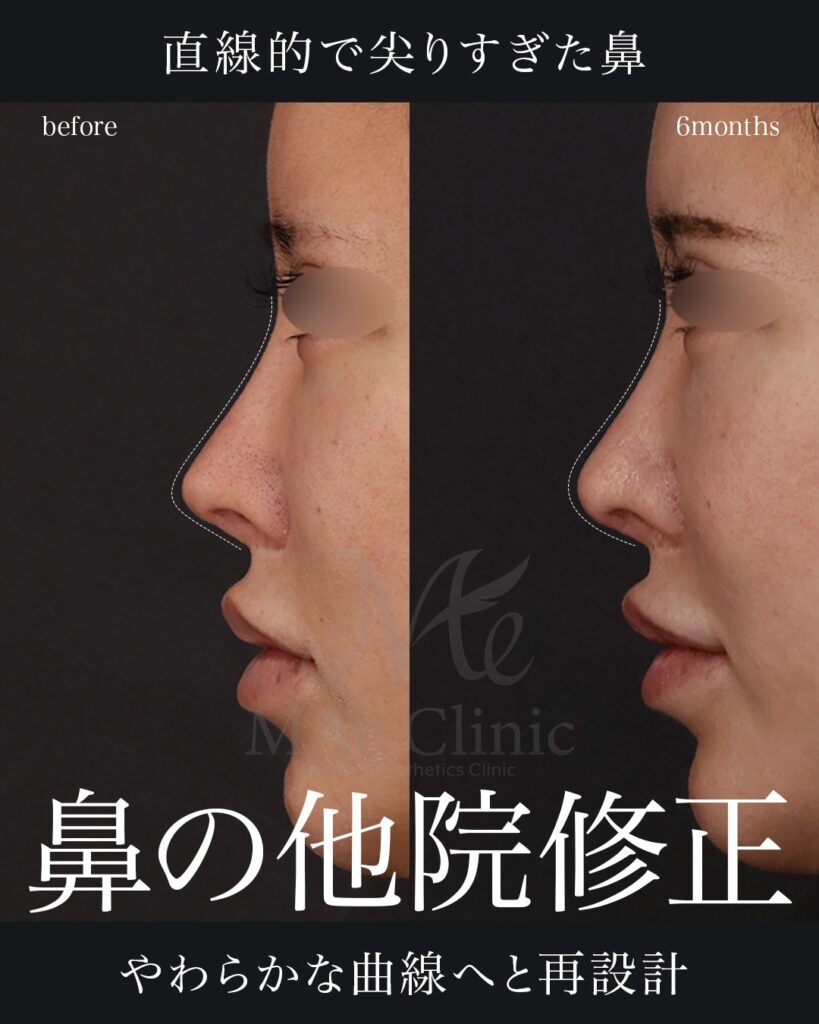 鼻尖形成
鼻尖軟骨移植
土手再建
他院修正 前田翔医師症例