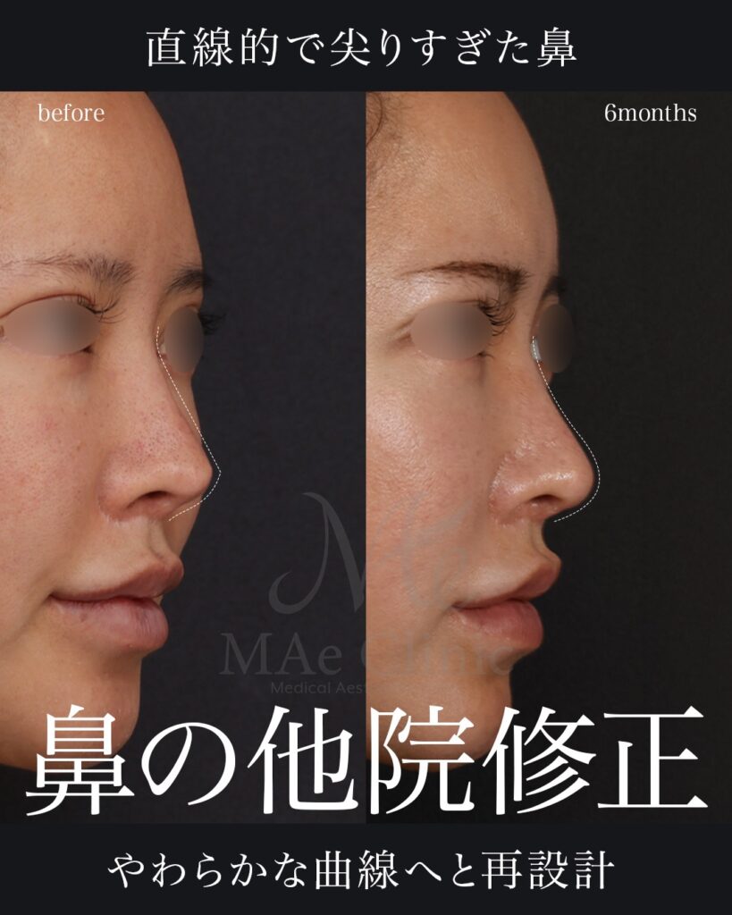鼻尖形成 鼻尖軟骨移植 土手再建 他院修正 前田翔医師症例