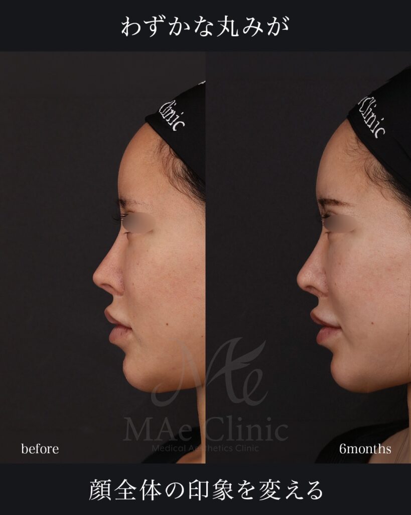 鼻尖形成 鼻尖軟骨移植 土手再建 他院修正 前田翔医師症例