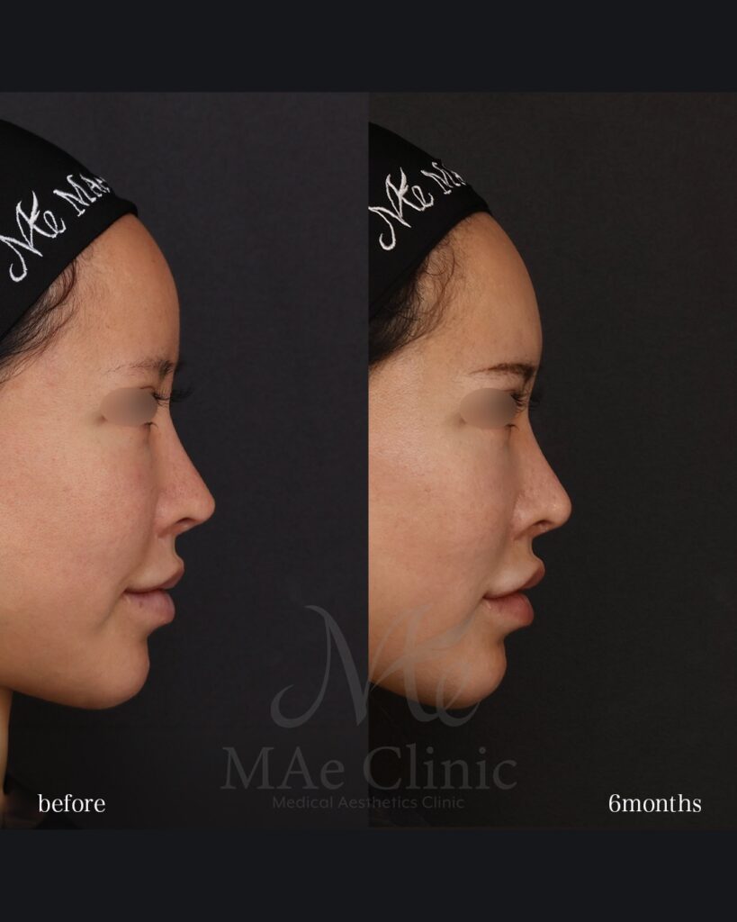 鼻尖形成 鼻尖軟骨移植 土手再建 他院修正 前田翔医師症例