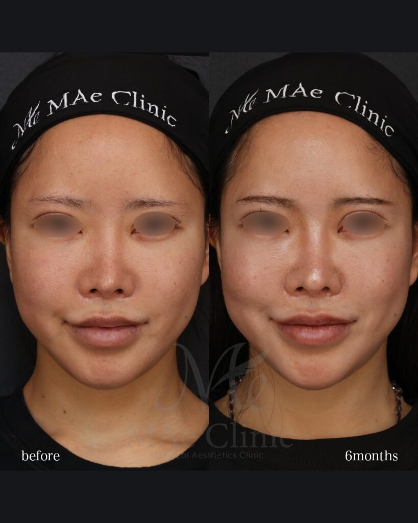 鼻尖形成 鼻尖軟骨移植 土手再建 他院修正 前田翔医師症例