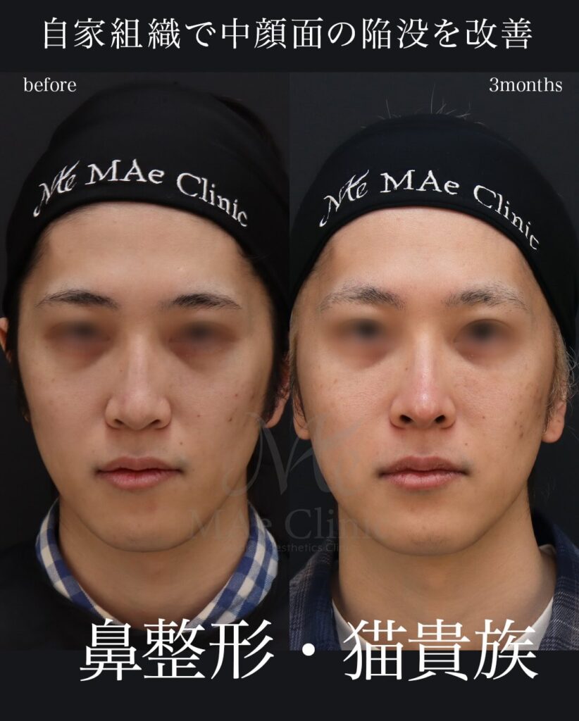 鼻中隔延長（肋軟骨） 鼻尖形成 鼻尖軟骨移植 猫貴族手術（肋軟骨） 望月正人医師症例