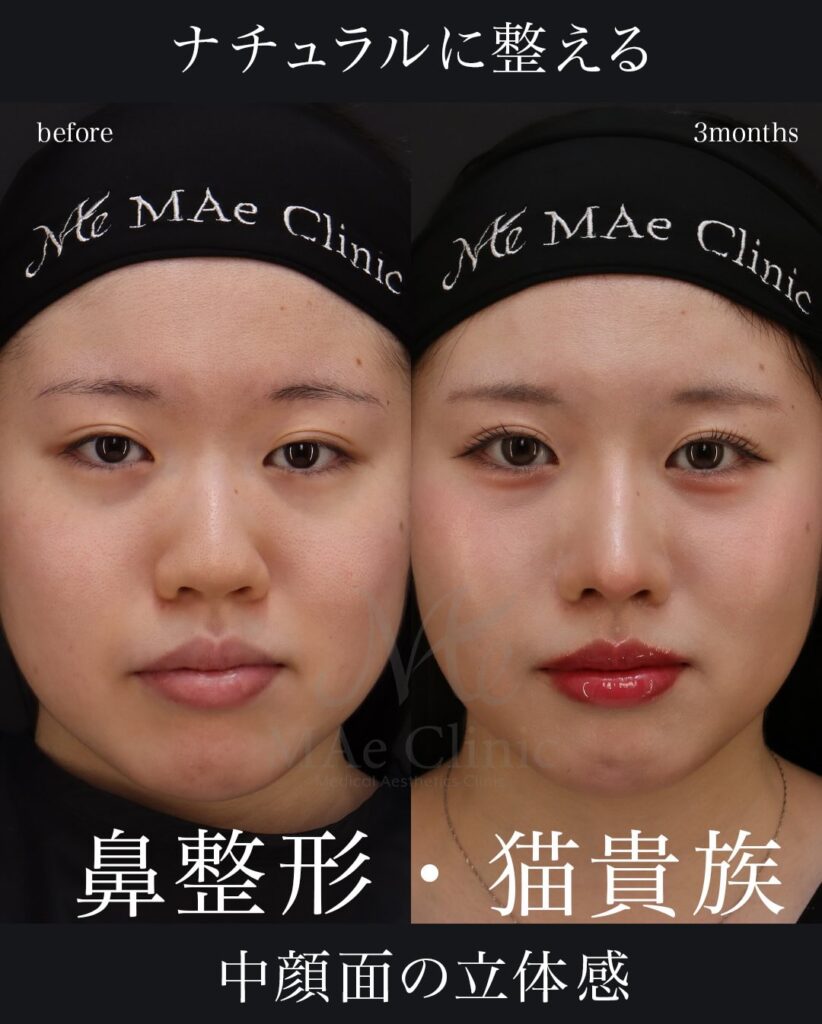 鼻中隔延長（肋軟骨）
鼻尖形成
鼻尖軟骨移植
猫貴族手術（肋軟骨）
望月正人医師症例