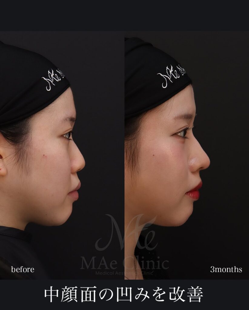 鼻中隔延長（肋軟骨） 鼻尖形成 鼻尖軟骨移植 猫貴族手術（肋軟骨） 望月正人医師症例