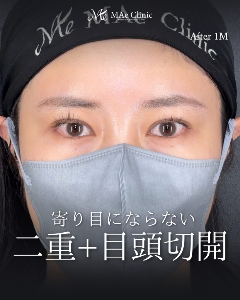 目頭切開（リドレープ法） 二重埋没法（裏留め） 前之園健太医師症例