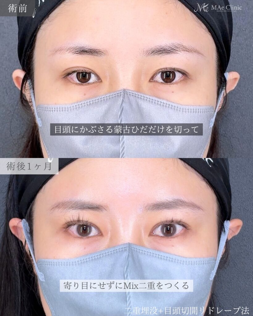 目頭切開(リドレープ法)
二重埋没法(裏留め)
前之園健太医師症例