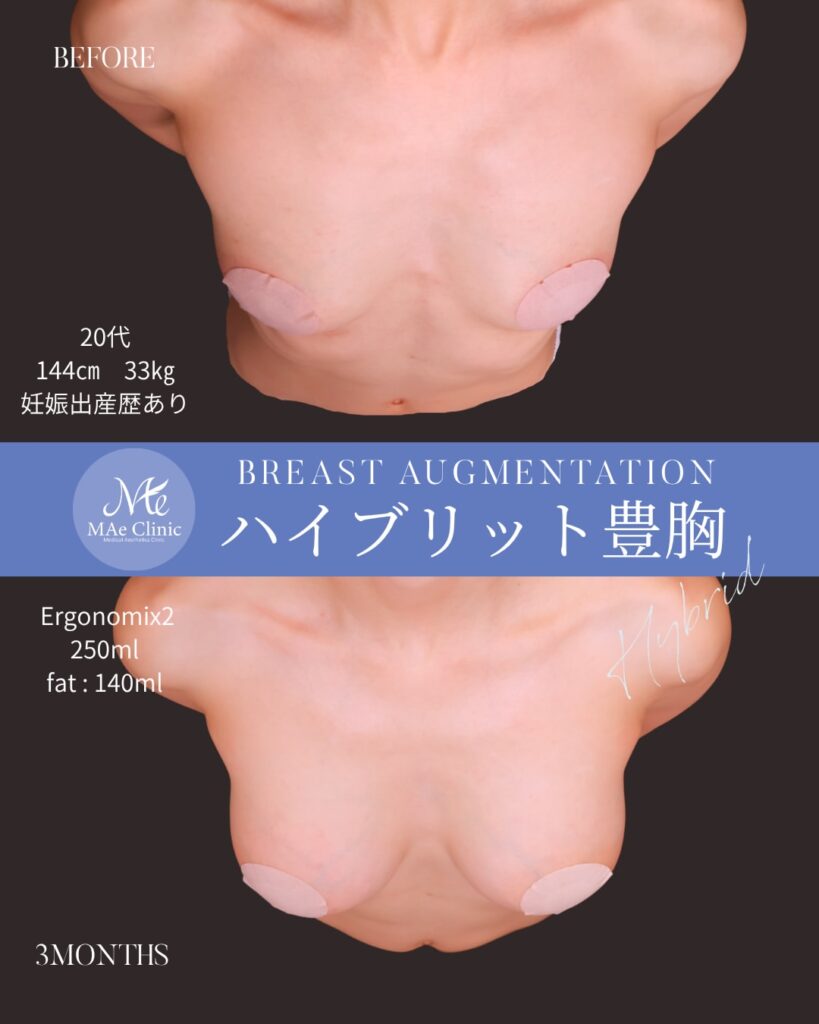 ハイブリッド豊胸 シリコンバッグ(Motiva Ergonomix2):両側250ml 脂肪注入:Total 140ml 木下恵里沙医師症例