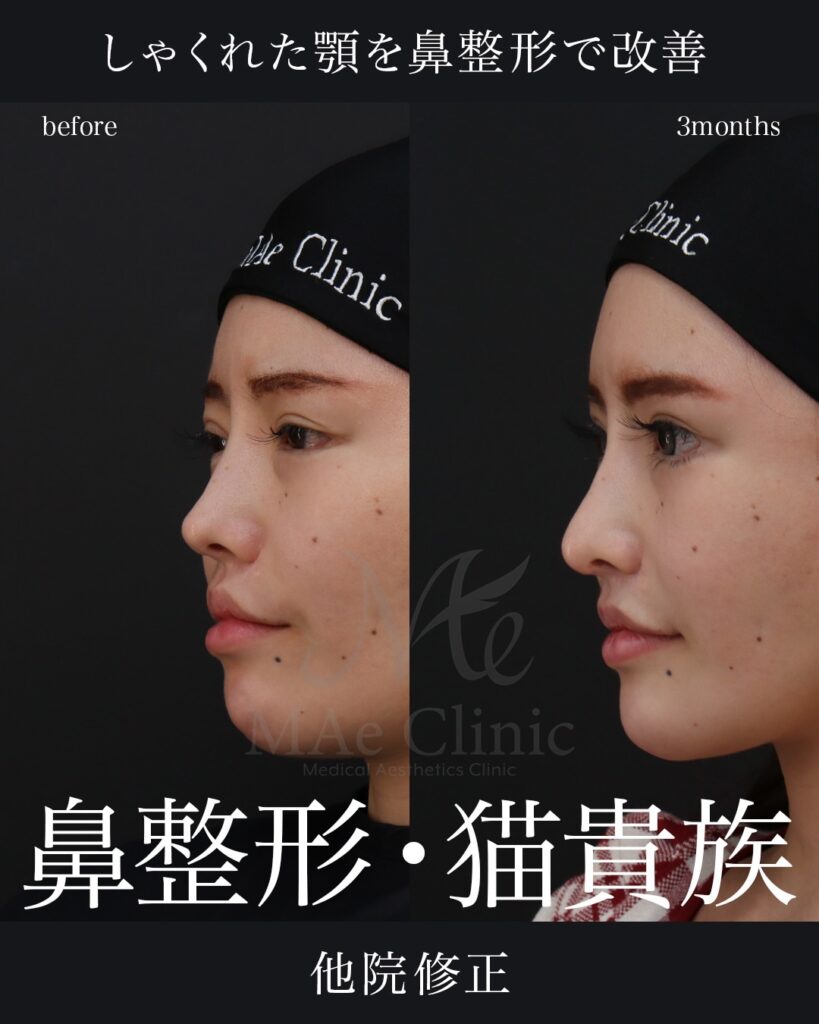 鼻中隔延長(肋軟骨)
鼻尖形成
鼻尖軟骨移植
鼻骨骨切り
隆鼻(肋軟骨)
他院プロテーゼ抜去
猫貴族手術(肋軟骨)
※頬骨アークインフラクチャ・顎先軟骨移植も同時施術
前田翔医師症例