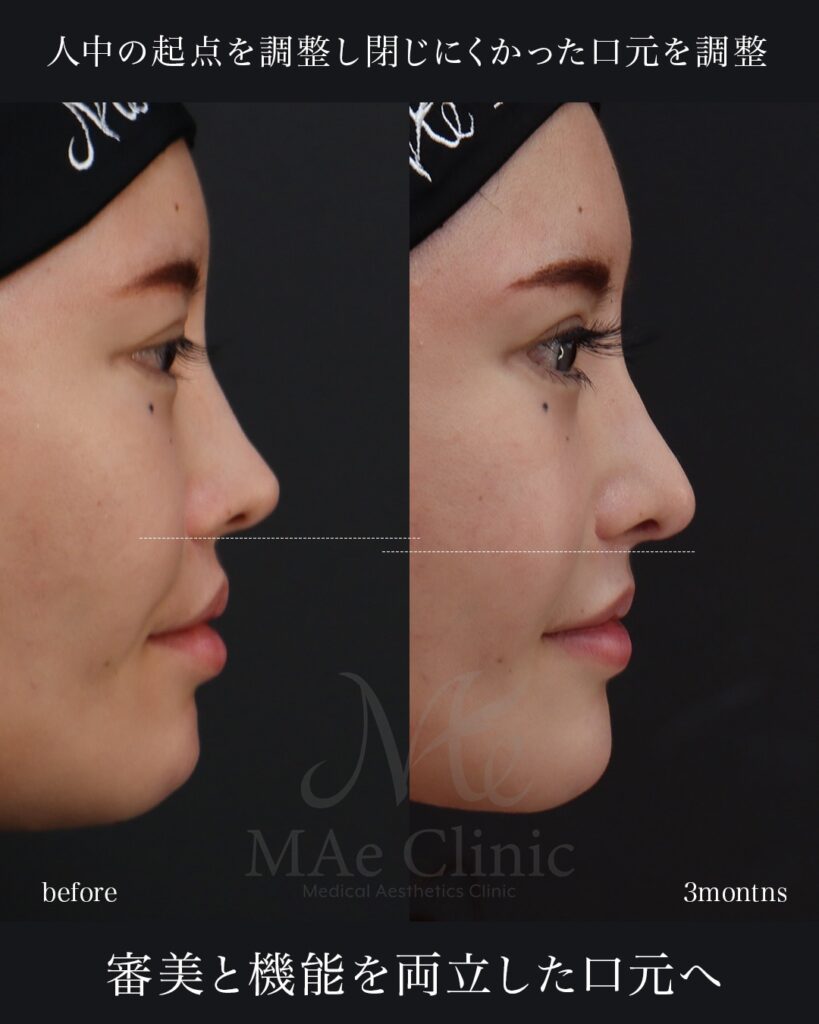 鼻中隔延長(肋軟骨) 鼻尖形成 鼻尖軟骨移植 鼻骨骨切り 隆鼻(肋軟骨) 他院プロテーゼ抜去 猫貴族手術(肋軟骨) ※頬骨アークインフラクチャ・顎先軟骨移植も同時施術 前田翔医師症例