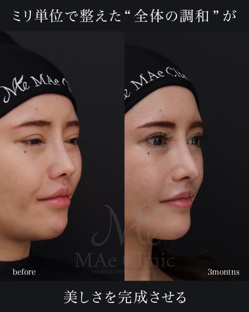 鼻中隔延長(肋軟骨) 鼻尖形成 鼻尖軟骨移植 鼻骨骨切り 隆鼻(肋軟骨) 他院プロテーゼ抜去 猫貴族手術(肋軟骨) ※頬骨アークインフラクチャ・顎先軟骨移植も同時施術 前田翔医師症例