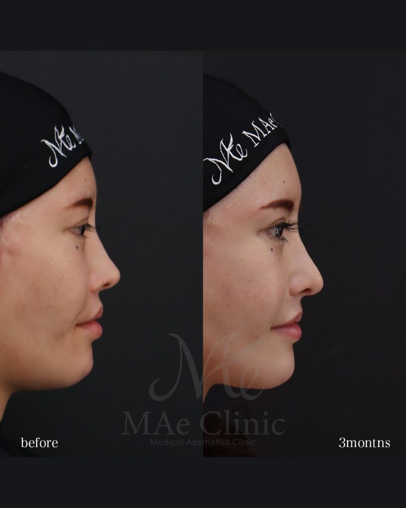 鼻中隔延長(肋軟骨) 鼻尖形成 鼻尖軟骨移植 鼻骨骨切り 隆鼻(肋軟骨) 他院プロテーゼ抜去 猫貴族手術(肋軟骨) ※頬骨アークインフラクチャ・顎先軟骨移植も同時施術 前田翔医師症例