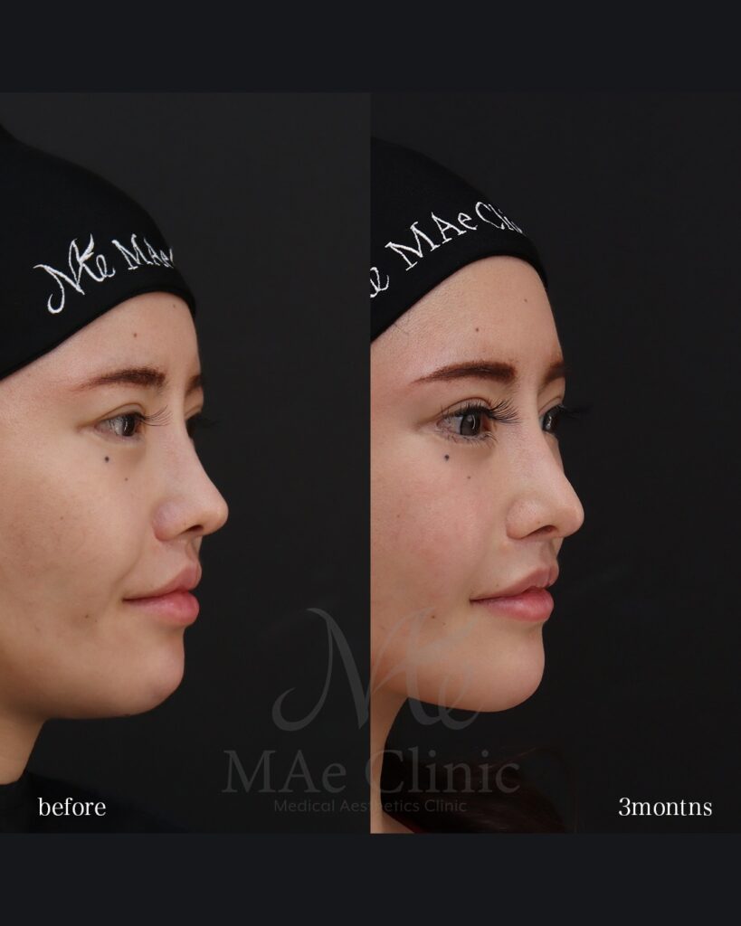 鼻中隔延長(肋軟骨) 鼻尖形成 鼻尖軟骨移植 鼻骨骨切り 隆鼻(肋軟骨) 他院プロテーゼ抜去 猫貴族手術(肋軟骨) ※頬骨アークインフラクチャ・顎先軟骨移植も同時施術 前田翔医師症例