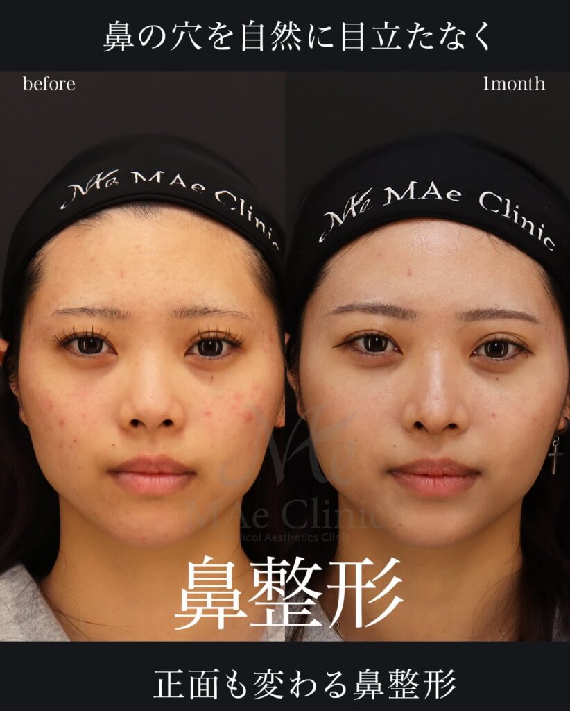 鼻中隔延長（肋軟骨）
鼻尖形成
鼻尖軟骨移植
望月正人医師症例