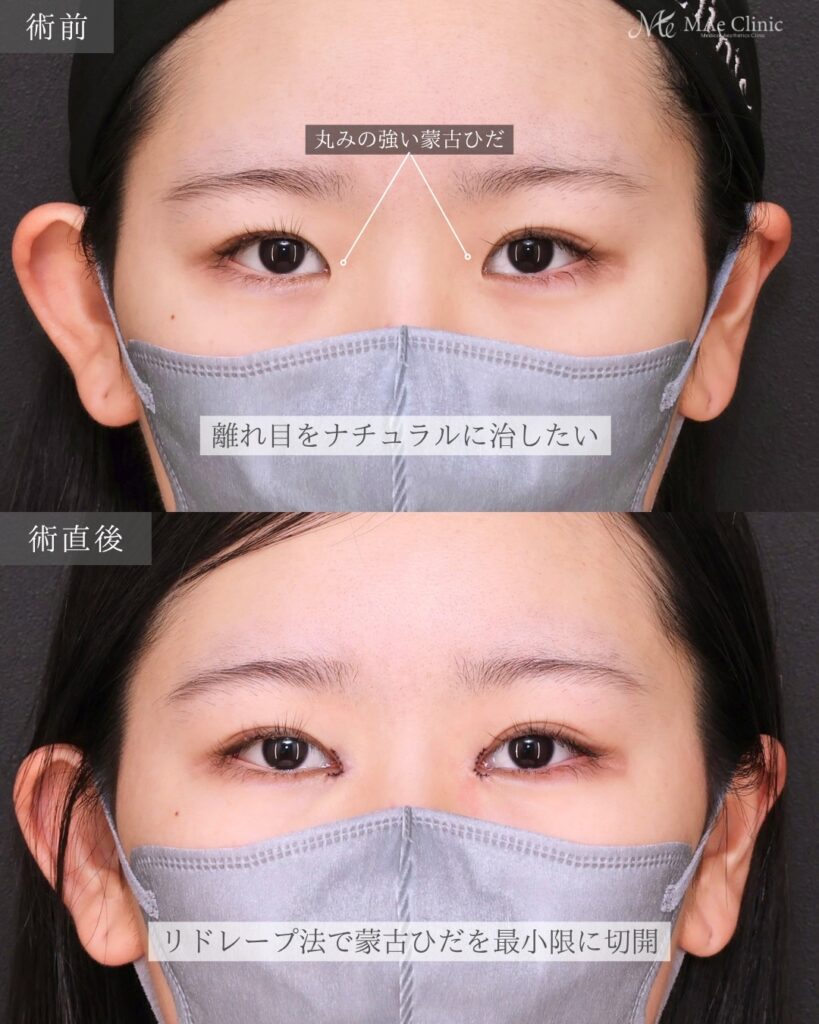 目頭切開（リドレープ法）前之園健太医師症例