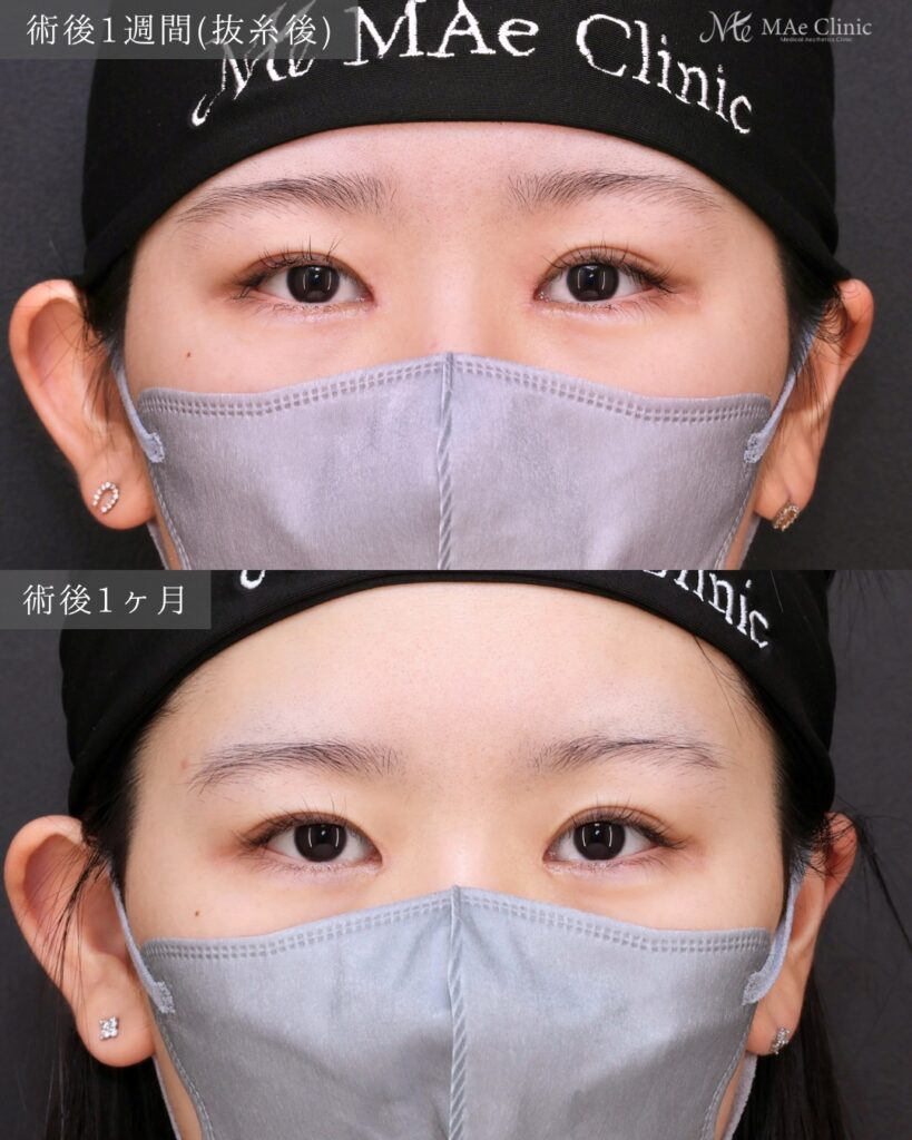 目頭切開（リドレープ法）前之園健太医師症例