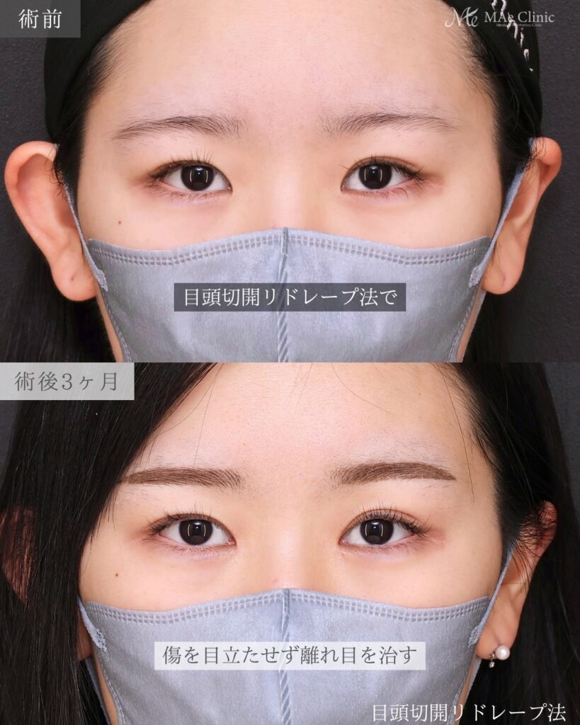 目頭切開（リドレープ法）前之園健太医師症例