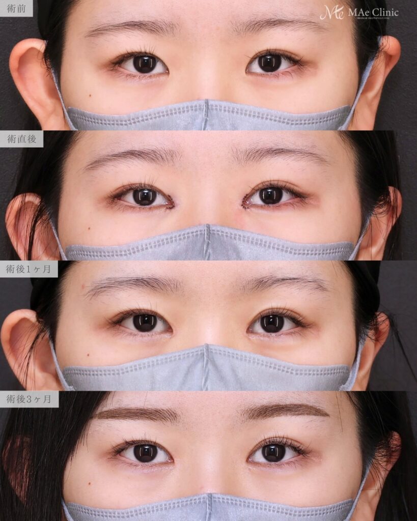 目頭切開（リドレープ法）前之園健太医師症例