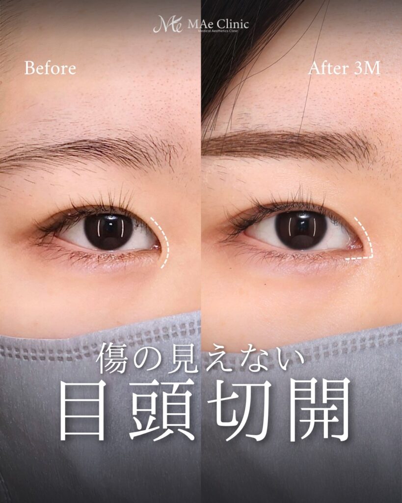 目頭切開（リドレープ法）前之園健太医師症例