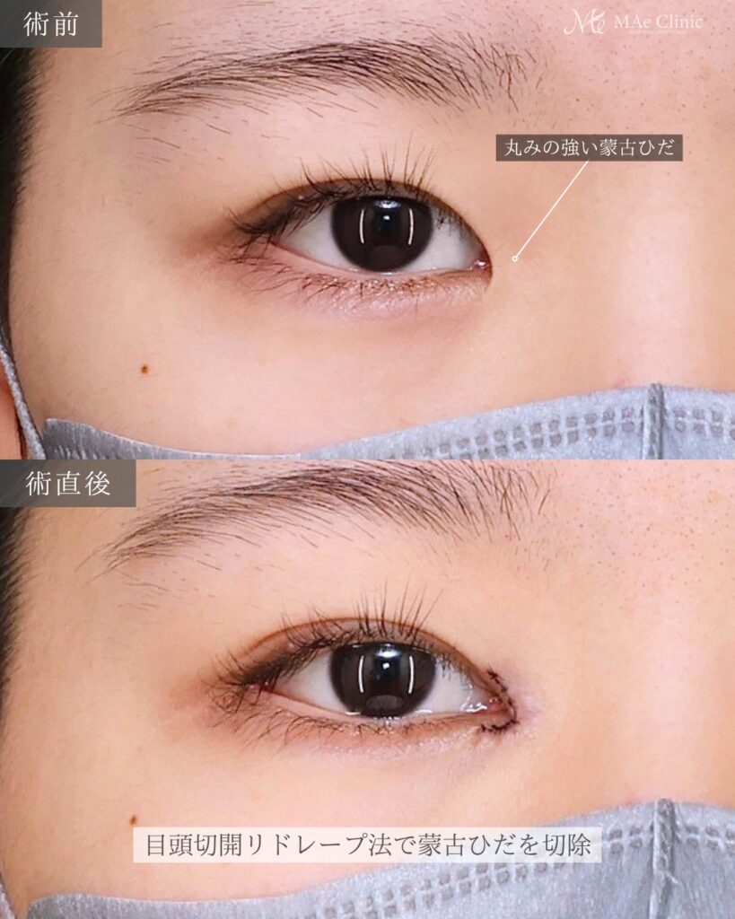 目頭切開（リドレープ法）前之園健太医師症例