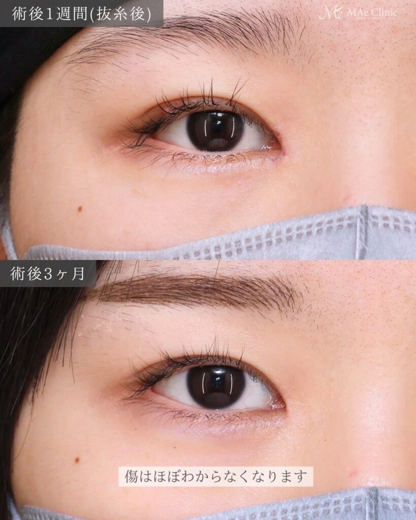 目頭切開（リドレープ法）前之園健太医師症例