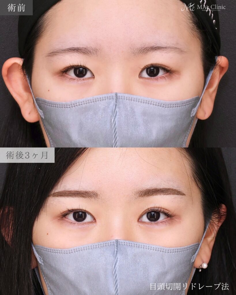 目頭切開（リドレープ法）前之園健太医師症例