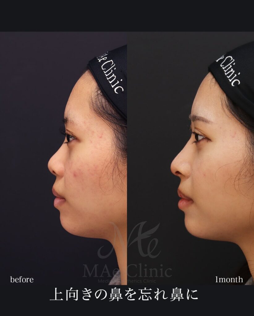 鼻中隔延長（肋軟骨） 鼻尖形成 鼻尖軟骨移植 望月正人医師症例