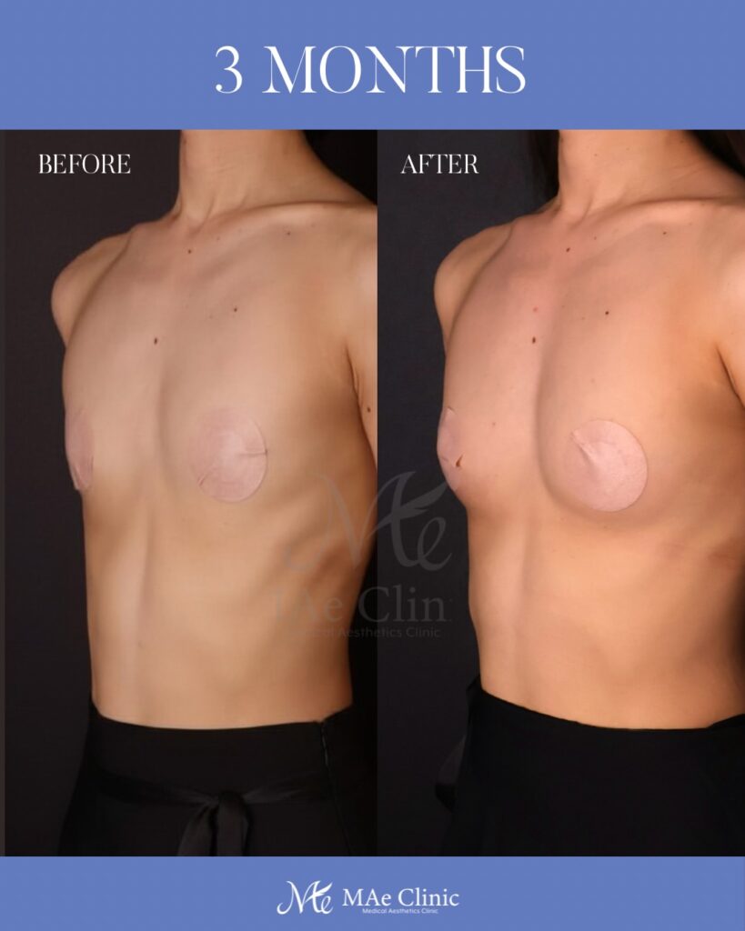 THE DAY豊胸 採取部位：大腿後面 処理方法：遠心分離 注入量：右150ml・左150ml（Total 300ml） 木下恵里沙医師症例