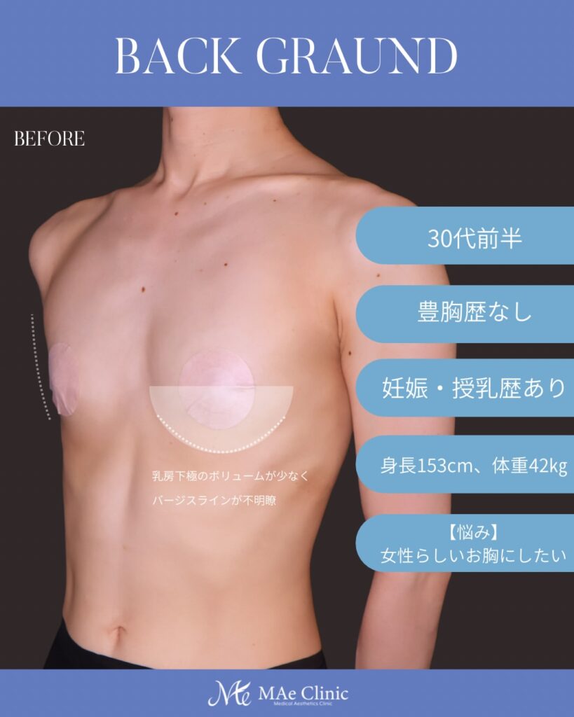 THE DAY豊胸 採取部位：大腿後面 処理方法：遠心分離 注入量：右150ml・左150ml（Total 300ml） 木下恵里沙医師症例