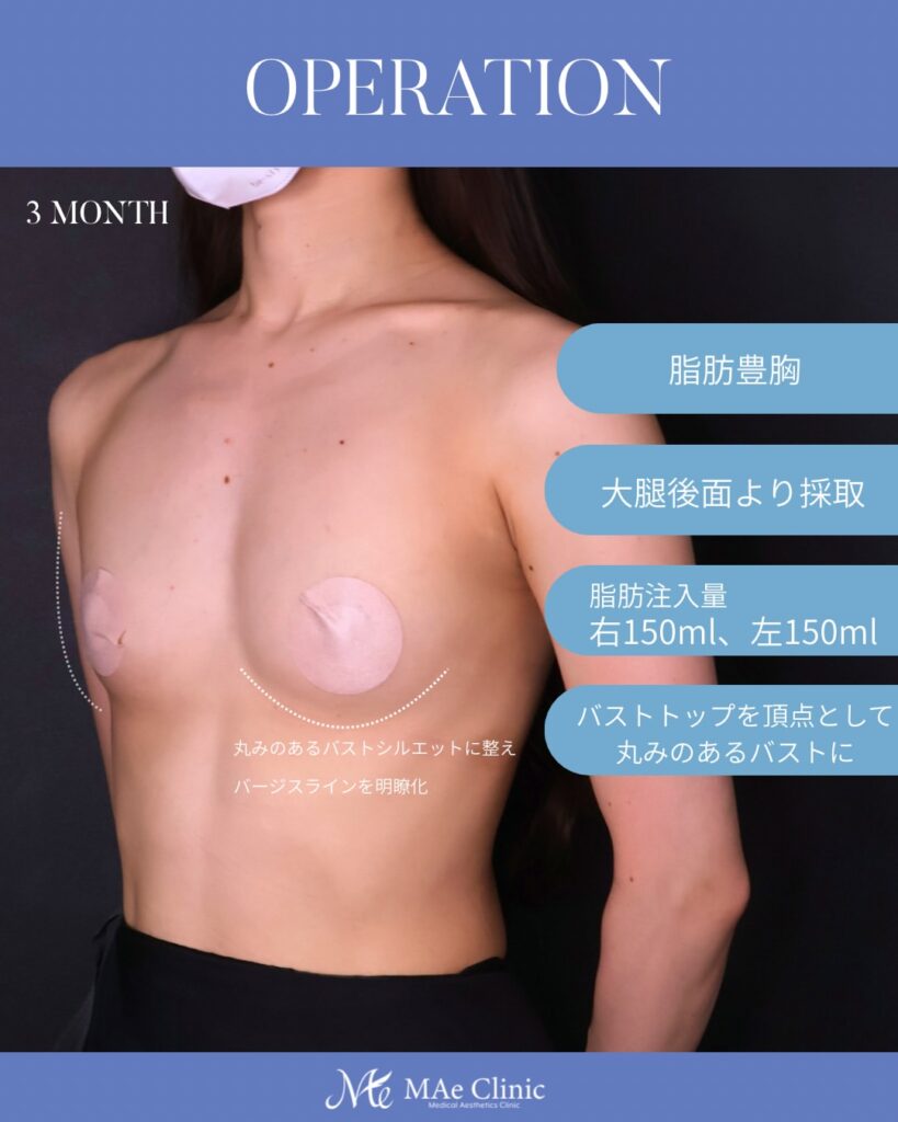 THE DAY豊胸 採取部位：大腿後面 処理方法：遠心分離 注入量：右150ml・左150ml（Total 300ml） 木下恵里沙医師症例