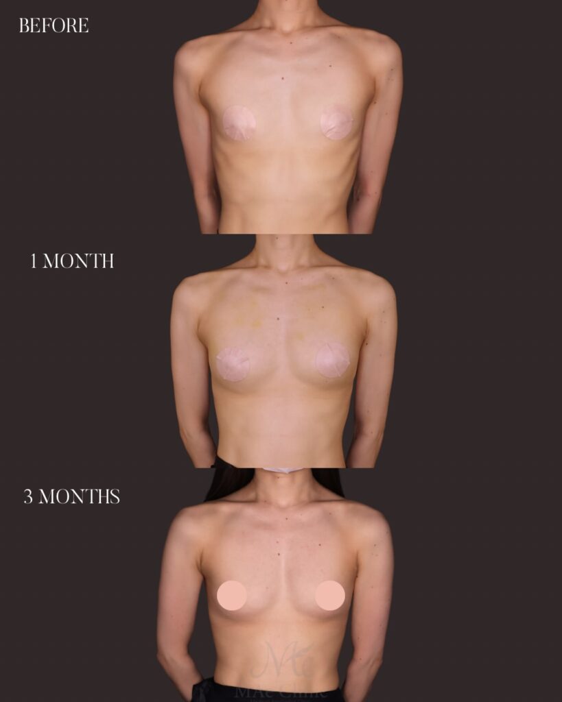 THE DAY豊胸 採取部位：大腿後面 処理方法：遠心分離 注入量：右150ml・左150ml（Total 300ml） 木下恵里沙医師症例