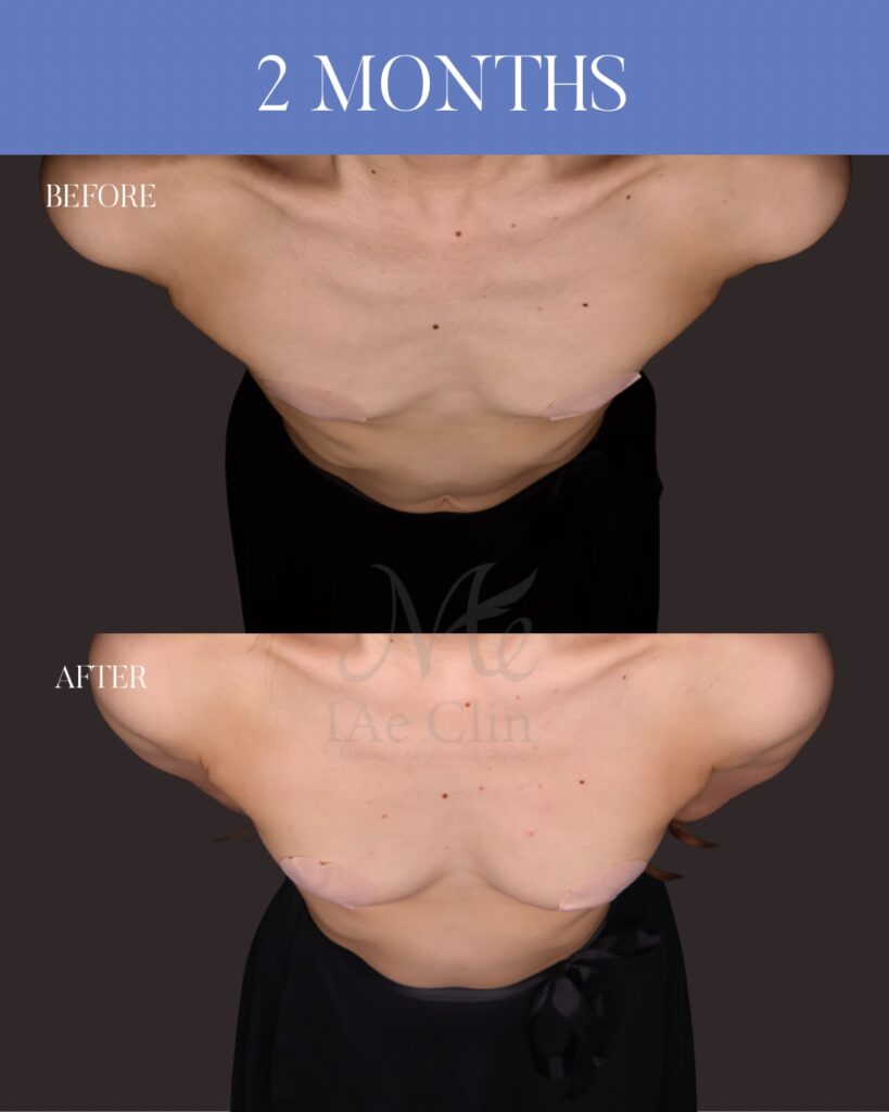 THE DAY豊胸 採取部位：大腿後面 処理方法：遠心分離 注入量：右150ml・左150ml（Total 300ml） 木下恵里沙医師症例