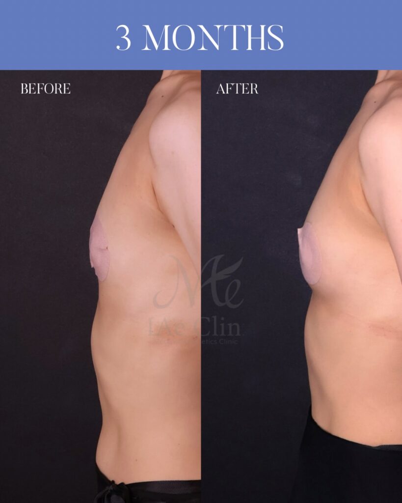 THE DAY豊胸 採取部位：大腿後面 処理方法：遠心分離 注入量：右150ml・左150ml（Total 300ml） 木下恵里沙医師症例