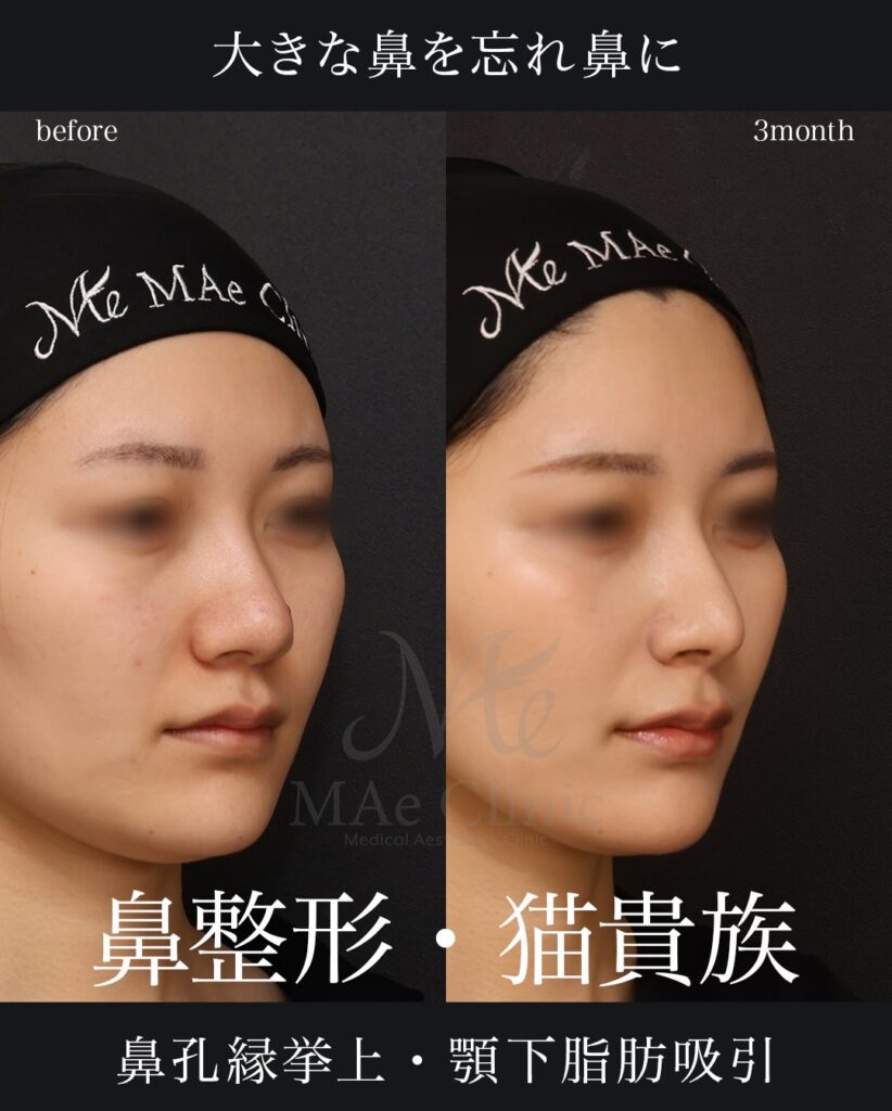 鼻中隔延長（肋軟骨） 鼻尖形成 鼻尖軟骨移植 猫貴族手術（肋軟骨） 鼻孔縁挙上 顎下脂肪吸引 望月正人医師症例