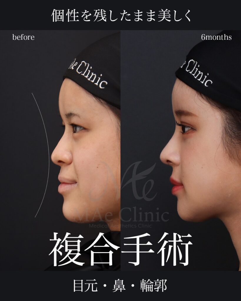 鼻中隔延長（肋軟骨）
鼻尖形成
鼻尖軟骨移植
猫貴族手術（肋軟骨）
骨切り（Vライン＋顎）
二重埋没法（表どめ）
前田翔医師症例