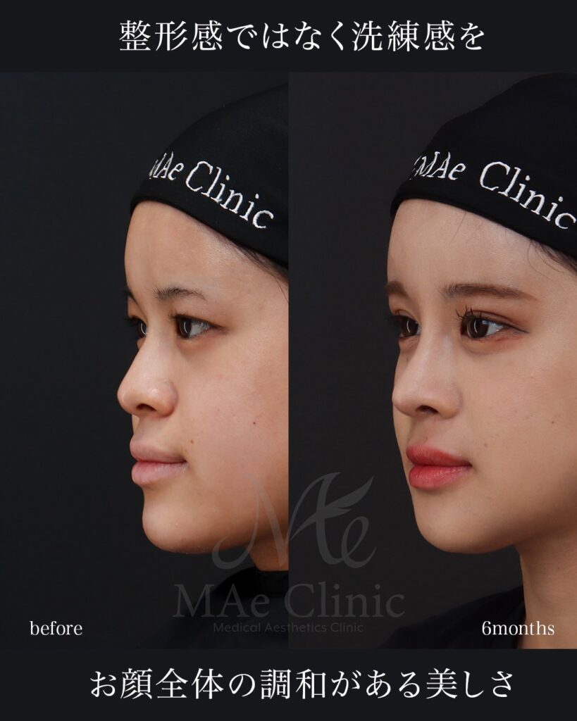 鼻中隔延長（肋軟骨） 鼻尖形成 鼻尖軟骨移植 猫貴族手術（肋軟骨） 骨切り（Vライン＋顎） 二重埋没法（表どめ） 前田翔医師症例