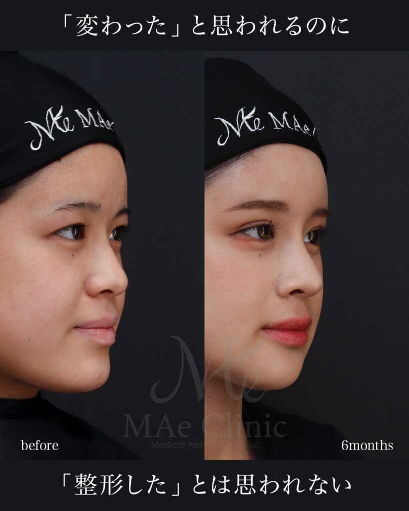 鼻中隔延長（肋軟骨） 鼻尖形成 鼻尖軟骨移植 猫貴族手術（肋軟骨） 骨切り（Vライン＋顎） 二重埋没法（表どめ） 前田翔医師症例