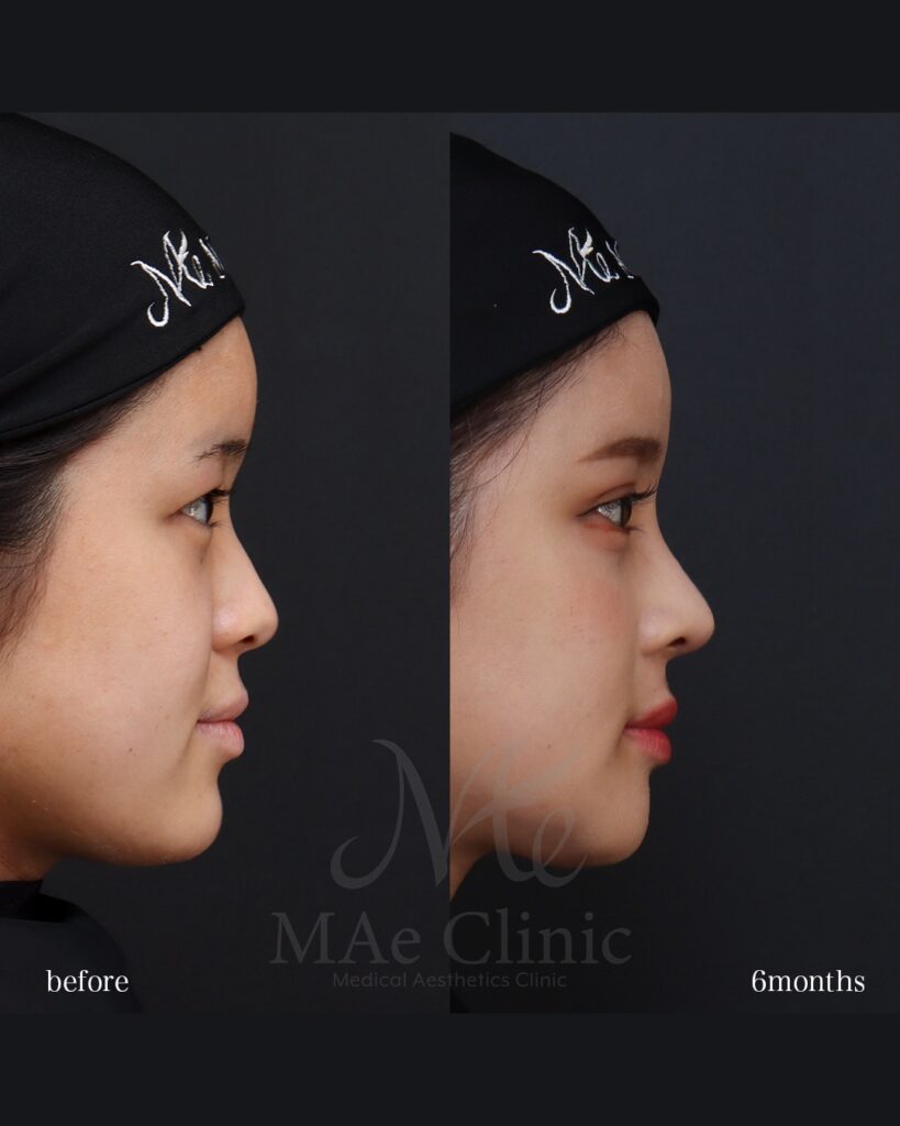 鼻中隔延長（肋軟骨） 鼻尖形成 鼻尖軟骨移植 猫貴族手術（肋軟骨） 骨切り（Vライン＋顎） 二重埋没法（表どめ） 前田翔医師症例