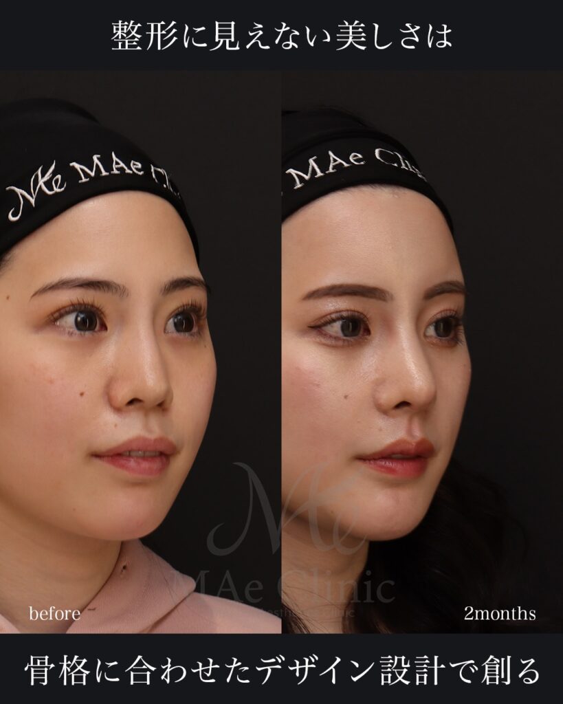 鼻中隔延長（肋軟骨） 鼻尖形成 鼻尖軟骨移植 隆鼻（肋軟骨） 他院プロテーゼ抜去 猫貴族手術（肋軟骨） 顎形成 脂肪注入（額） 前田翔医師症例