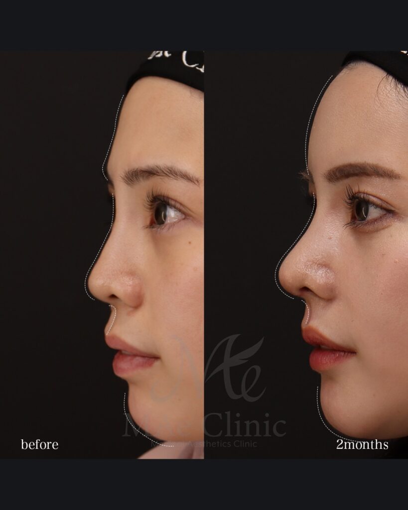 鼻中隔延長（肋軟骨） 鼻尖形成 鼻尖軟骨移植 隆鼻（肋軟骨） 他院プロテーゼ抜去 猫貴族手術（肋軟骨） 顎形成 脂肪注入（額） 前田翔医師症例