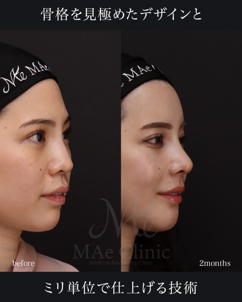 鼻中隔延長（肋軟骨） 鼻尖形成 鼻尖軟骨移植 隆鼻（肋軟骨） 他院プロテーゼ抜去 猫貴族手術（肋軟骨） 顎形成 脂肪注入（額） 前田翔医師症例