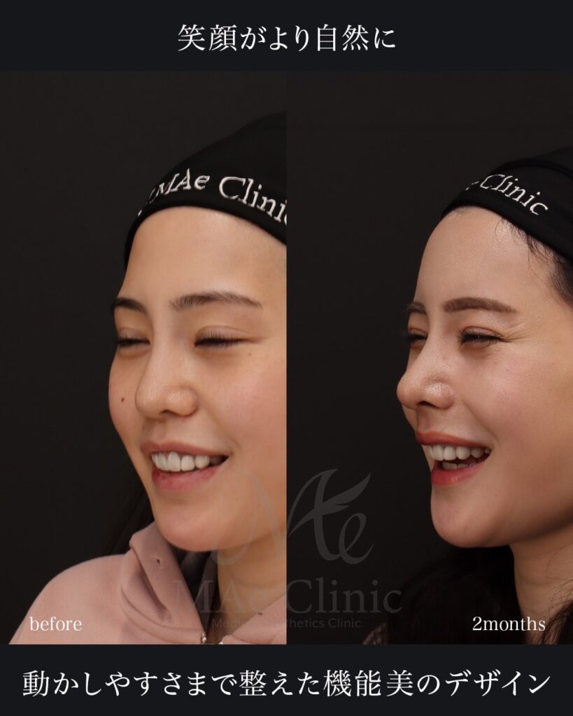 鼻中隔延長（肋軟骨） 鼻尖形成 鼻尖軟骨移植 隆鼻（肋軟骨） 他院プロテーゼ抜去 猫貴族手術（肋軟骨） 顎形成 脂肪注入（額） 前田翔医師症例