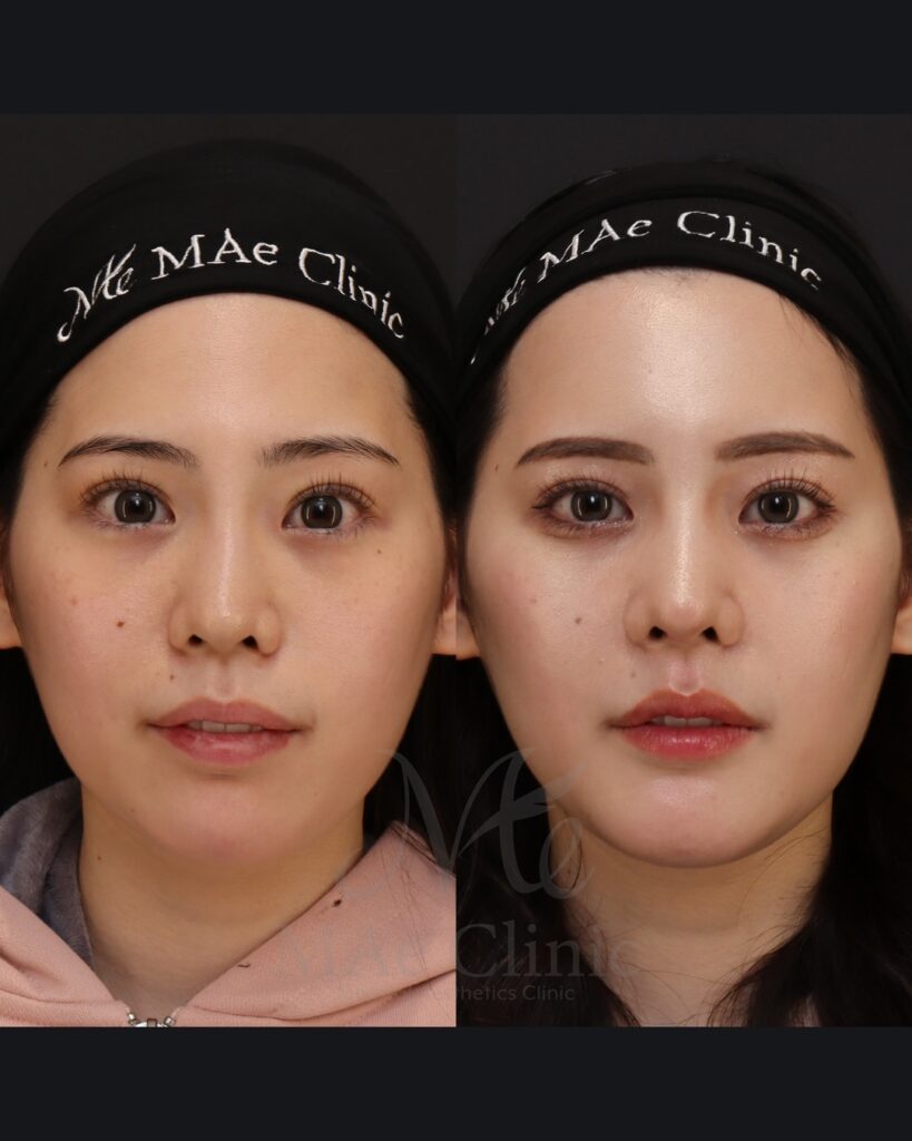 鼻中隔延長（肋軟骨） 鼻尖形成 鼻尖軟骨移植 隆鼻（肋軟骨） 他院プロテーゼ抜去 猫貴族手術（肋軟骨） 顎形成 脂肪注入（額） 前田翔医師症例