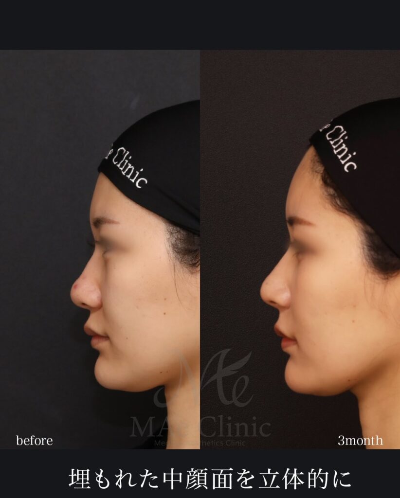 鼻中隔延長（肋軟骨） 鼻尖形成 鼻尖軟骨移植 猫貴族手術（肋軟骨） 鼻孔縁挙上 顎下脂肪吸引 望月正人医師症例