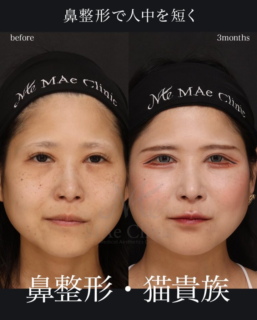 鼻中隔延長（肋軟骨） 鼻尖形成 鼻尖軟骨移植 猫貴族手術（肋軟骨） 望月正人医師症例